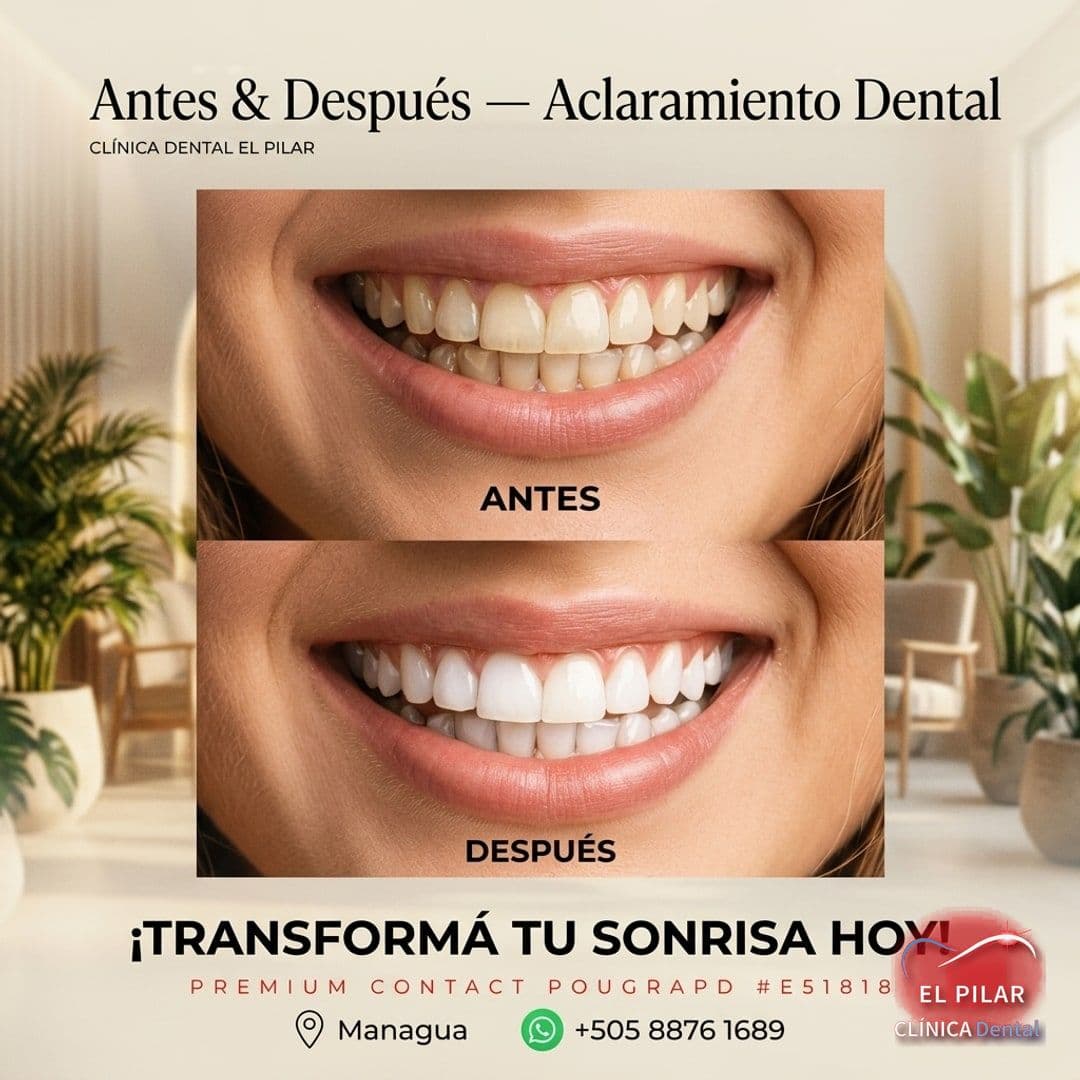 Aclaramiento Dental — Antes y Después