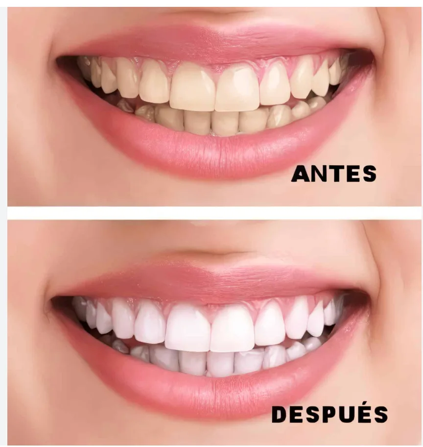 Aclaramiento Dental