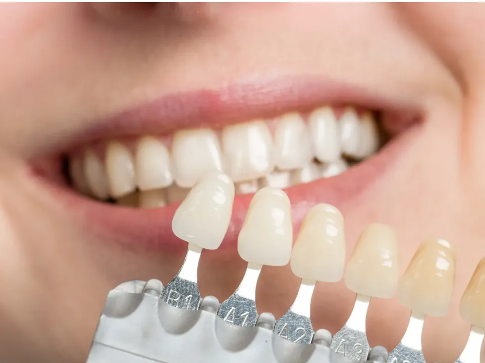 Carilla de Porcelana / Emax / Zirconio